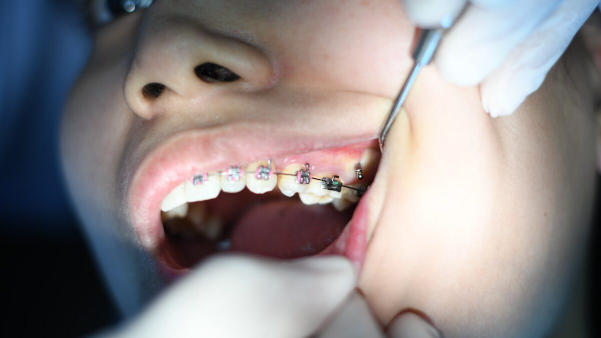Why You May Choose Teeth Aligners