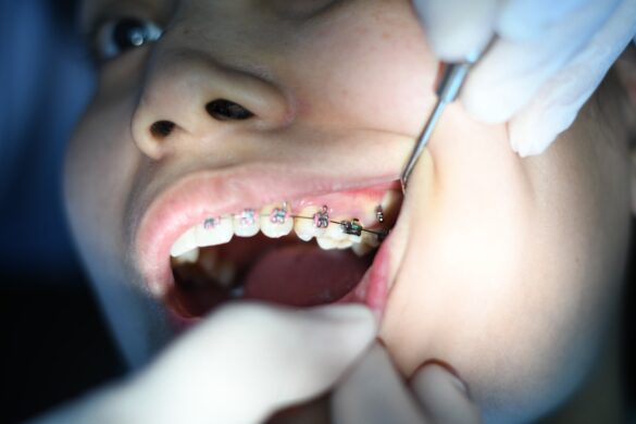 Why You May Choose Teeth Aligners